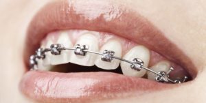 Orthodontic Malpractice