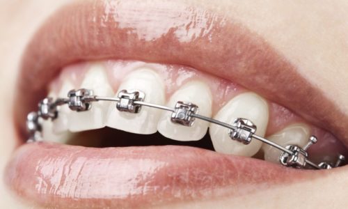 Orthodontic Malpractice