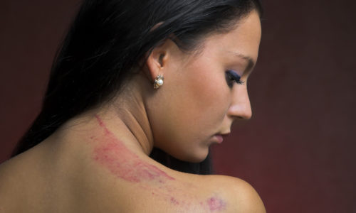 Scarring & Disfigurement Injuries